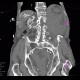 Aneurysm of abdominal aorta, AAA, ruptured, cardiac arrest, deceased: CT - Computed tomography